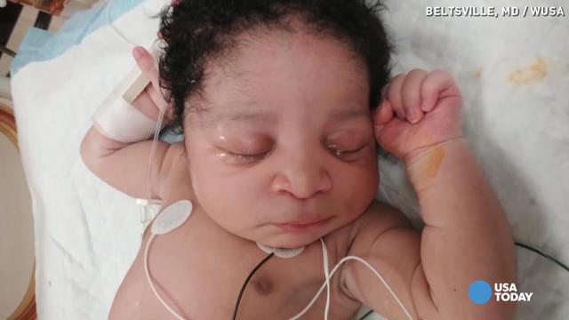 Parents Abandon Baby With Down Syndrome at Birth — Years Later