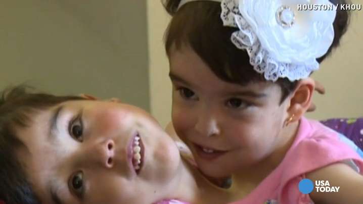 Conjoined Twins Who Share Heart Need Surgery To Survive