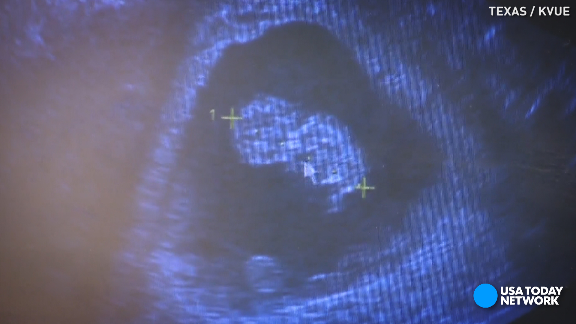 New law requires burying, cremating aborted fetal remains