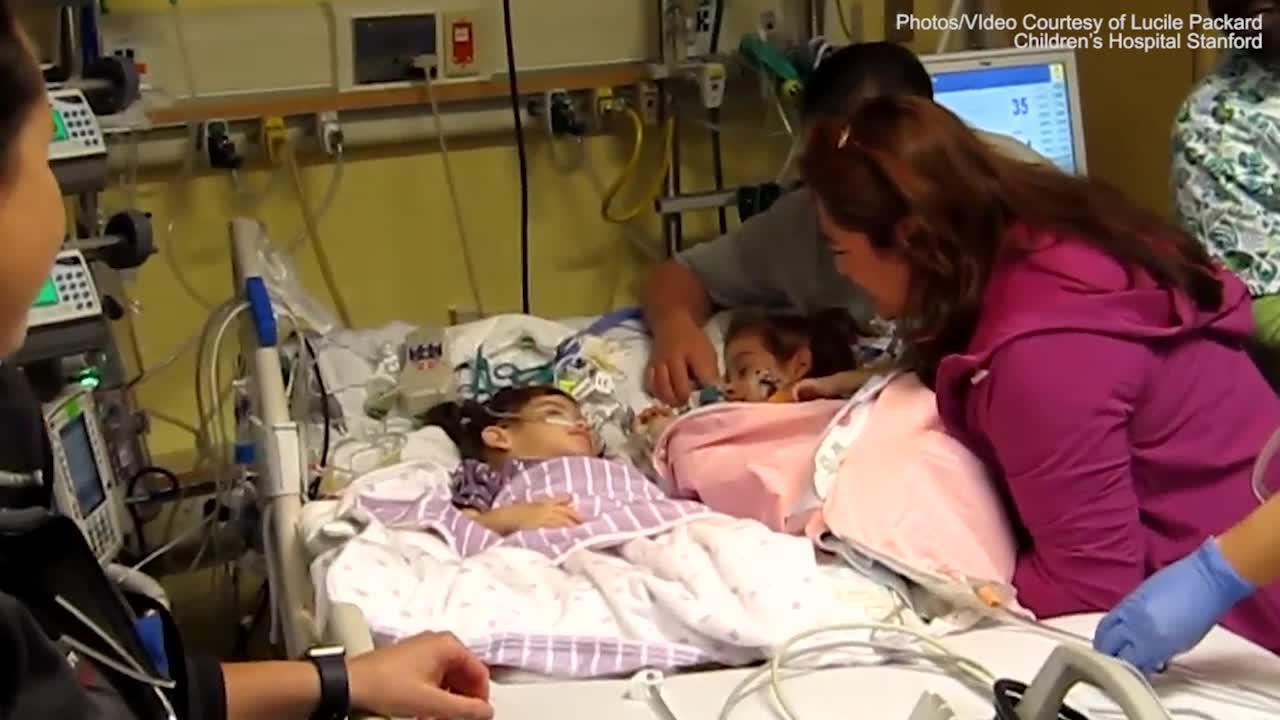 The Moment Conjoined Twins See Each Other After Separation
