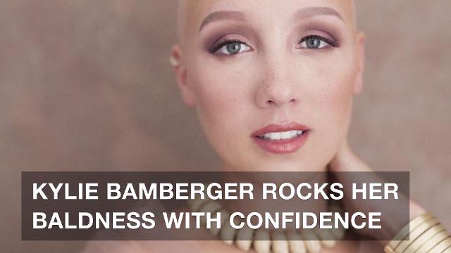 Bald Model Shows Confidence And Raises Awareness For Alopecia